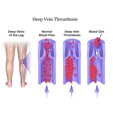 深静脉血栓（DVT）