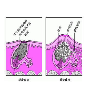 痤疮