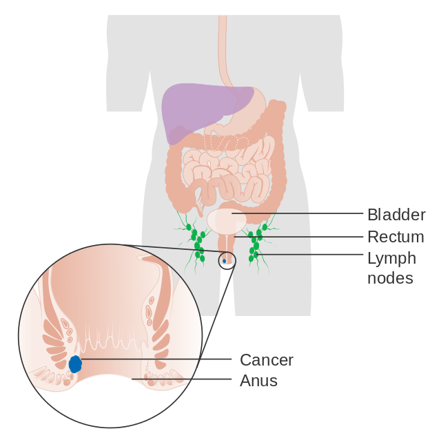 肛门癌（anal cancer）