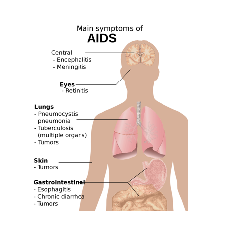 艾滋病（AIDS）