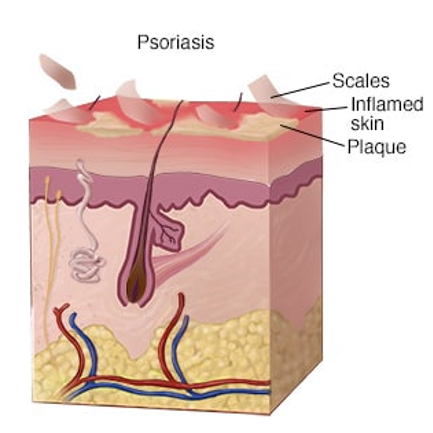 银屑病（Psoriasis）