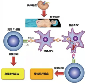 器官移植后免疫排斥（TR）