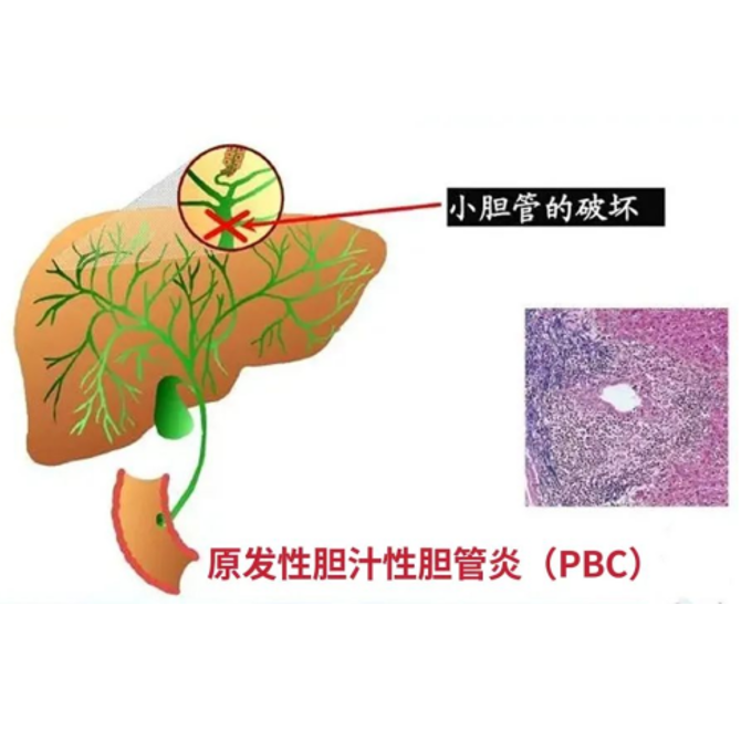 原发性胆汁性胆管炎（PBC）