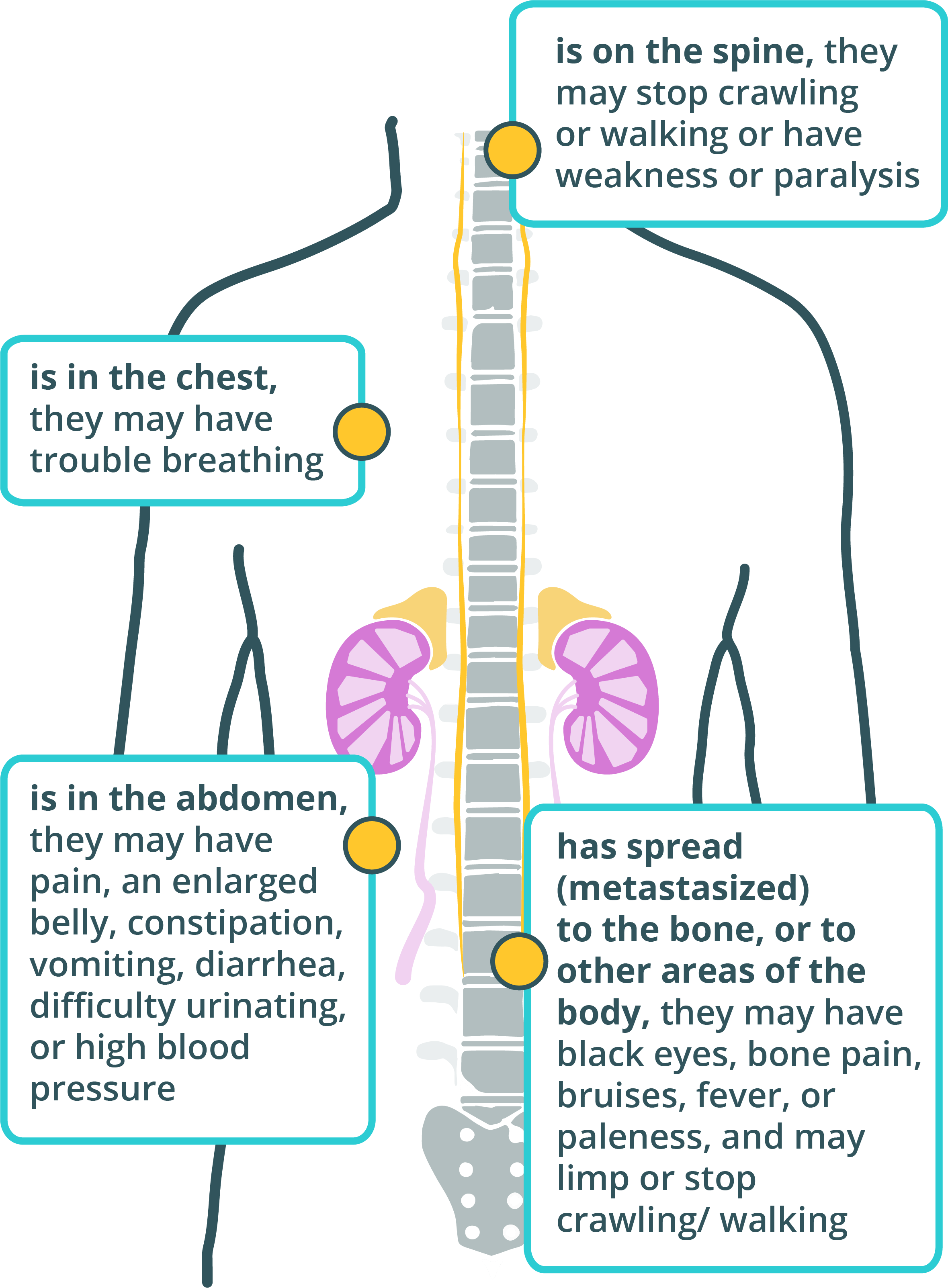 神经母细胞瘤 （Neuroblastoma）