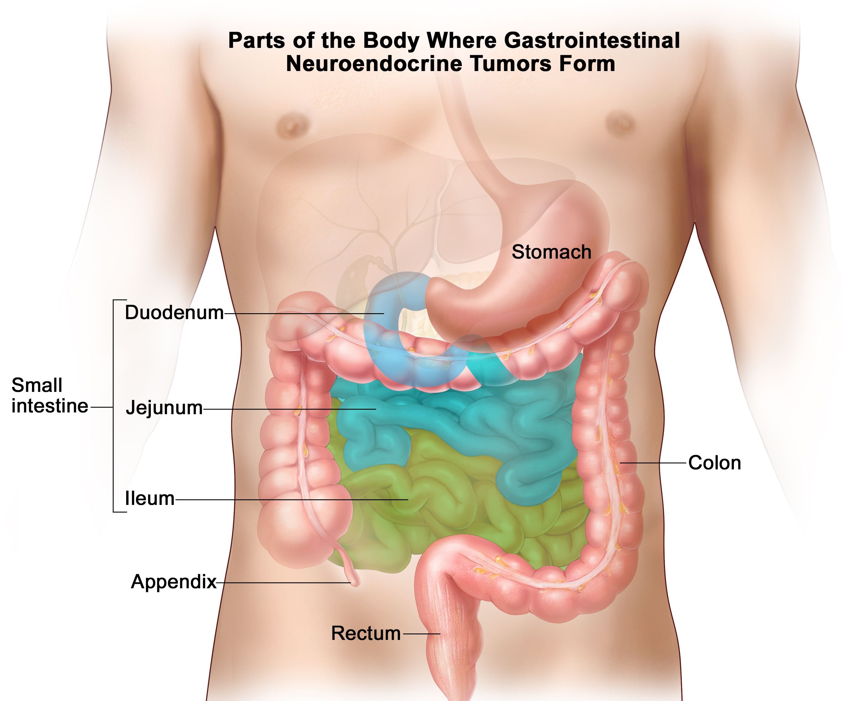 胃肠道类癌 (Gastrointestinal Carcinoid Tumors)