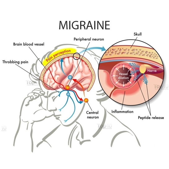 偏头痛（Migraine）