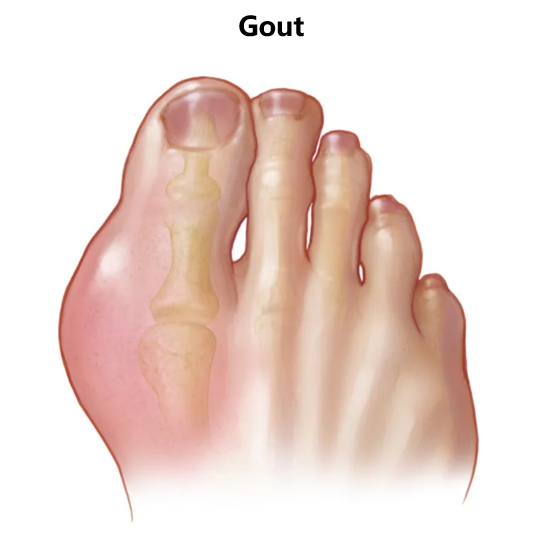 痛风（ Gout）