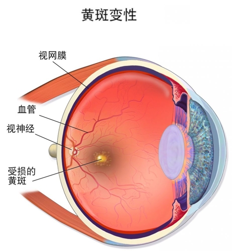 年龄相关性黄斑变性 (AMD) 