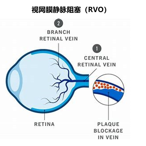 视网膜静脉阻塞（RVO）