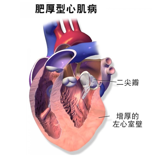 肥厚性心肌病（HCM）