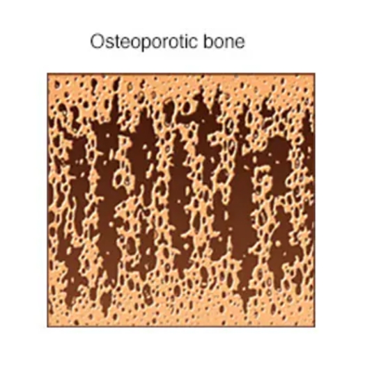 骨质疏松症（osteoporosis）