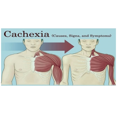 恶液质（cachexia）